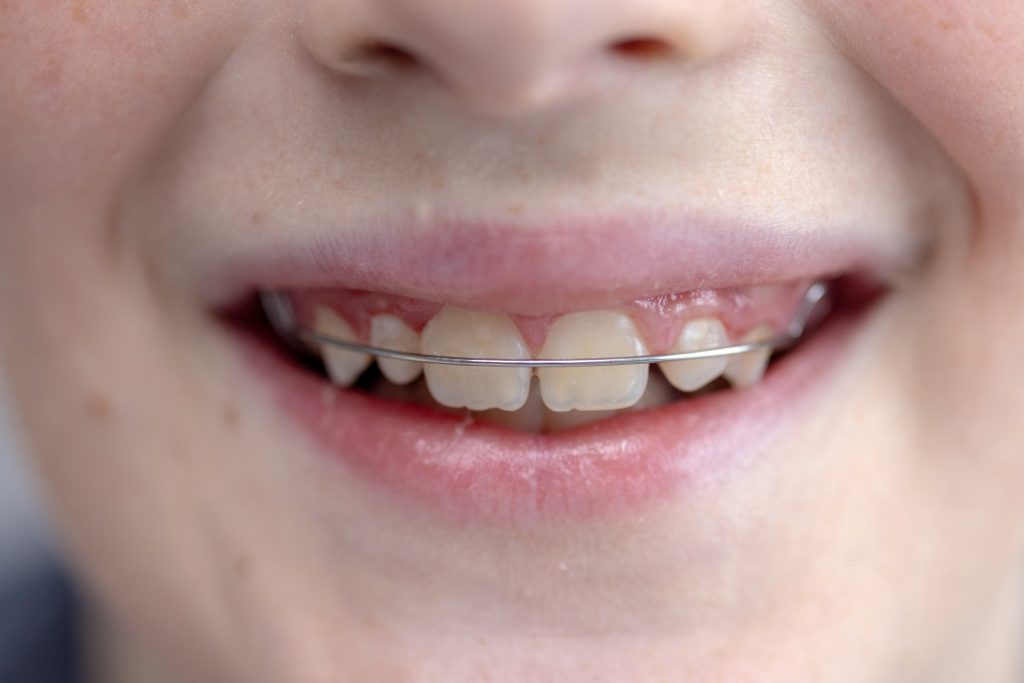 Stomatologia estetyczna - wide smile of teenage boy teeth with braces close 2025